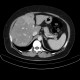 Carcinoma of sigmoid colon, metastasis of liver: CT - Computed tomography